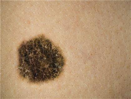 体内有癌,皮肤先知 若皮肤出现3种 症状 ,暗示癌细胞上门来访